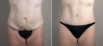 Parker Tummy Tuck Patient 54