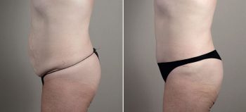 Parker Tummy Tuck Patient 54