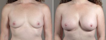 Mommy Makeover Patient 29