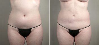 Mommy Makeover Patient 29