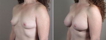 Mommy Makeover Patient 29