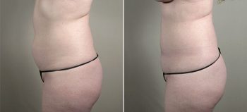 Mommy Makeover Patient 29