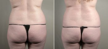 Mommy Makeover Patient 29