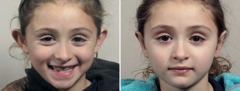 Otoplasty Patient 10