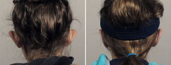 Otoplasty Patient 10