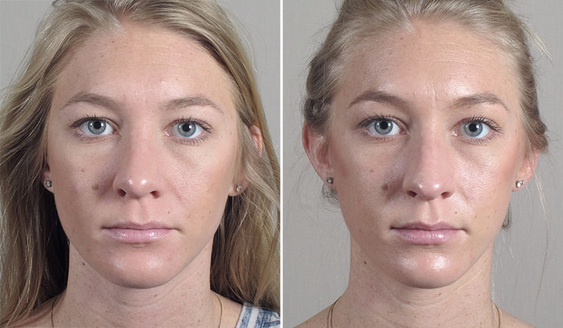 Rhinoplasty Patient 65