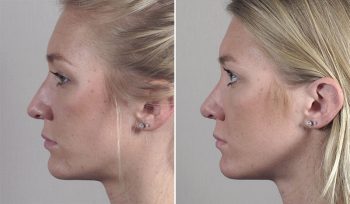 Rhinoplasty Patient 65