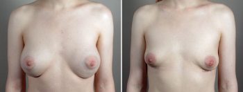 Breast Implant Removal Patient 34