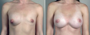 Removal & Replacement of Implants Patient 35