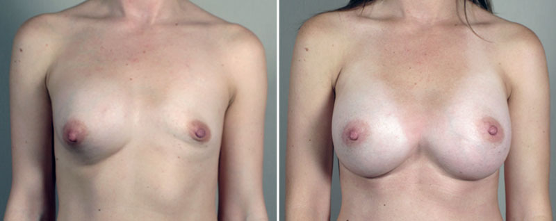 Removal & Replacement of Implants Patient 35