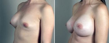 Removal & Replacement of Implants Patient 35