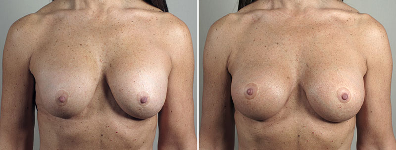 Removal & Replacement of Implants Patient 33