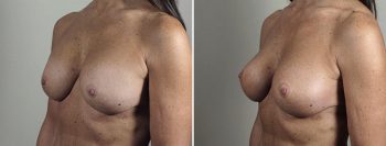 Removal & Replacement of Implants Patient 33