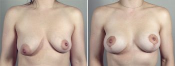 Breast Lift with Implants Patient 44