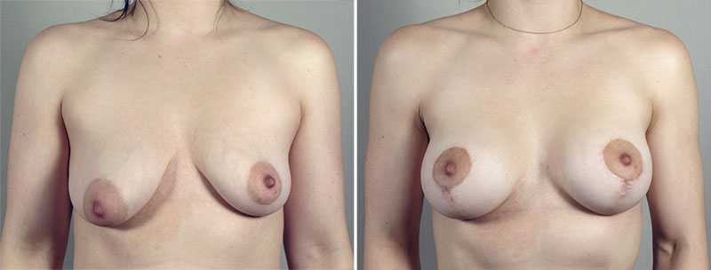 Breast Lift with Implants Patient 44