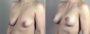 Breast Lift with Implants Patient 44