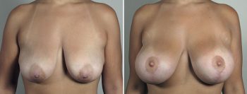 Breast Lift with Implants Patient 45