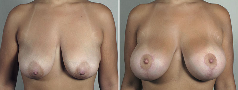 Breast Lift with Implants Patient 45