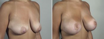 Breast Lift with Implants Patient 45