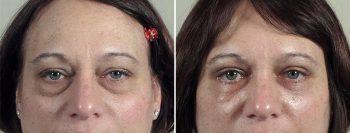 Upper & Lower Eyelid Lift Patient 19