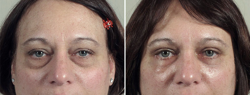Upper & Lower Eyelid Lift Patient 19