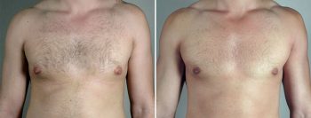 Gynecomastia Reduction Patient 56
