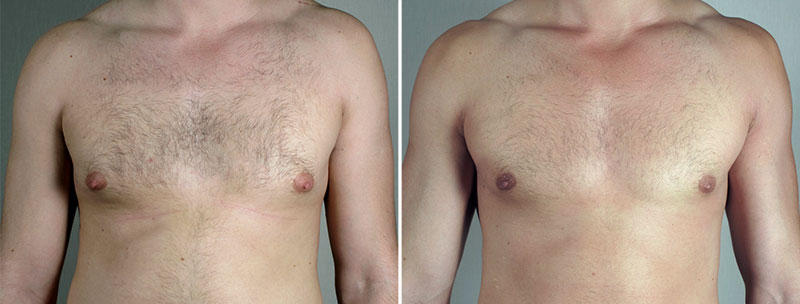 Gynecomastia Reduction Patient 56