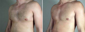 Gynecomastia Reduction Patient 56