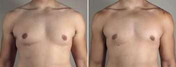 Gynecomastia Reduction Patient 55