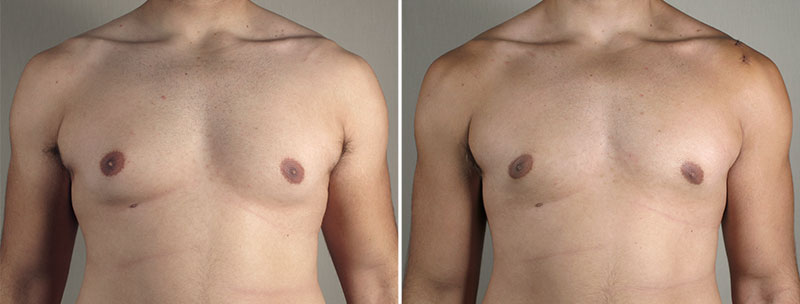 Gynecomastia Reduction Patient 55