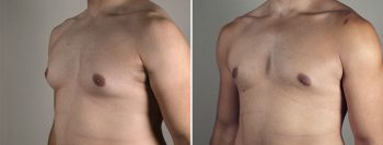 Gynecomastia Reduction Patient 55