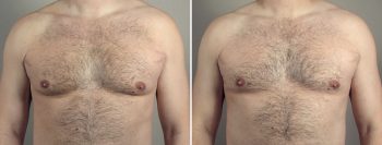 Male Liposuction Patient 27 & Gynecomastia