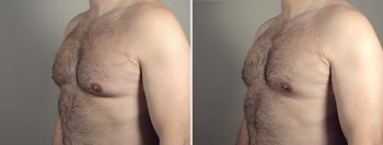 Male Liposuction Patient 27 & Gynecomastia