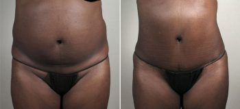 Parker Tummy Tuck Patient 55