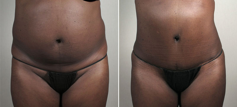 Parker Tummy Tuck Patient 55