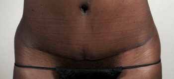 Parker Tummy Tuck Patient 55