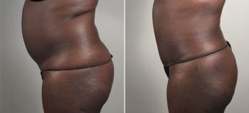Parker Tummy Tuck Patient 55