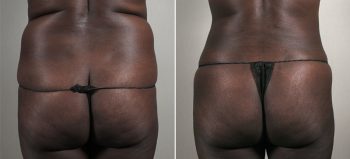 Parker Tummy Tuck Patient 55