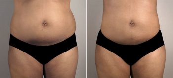 Liposuction Patient 38