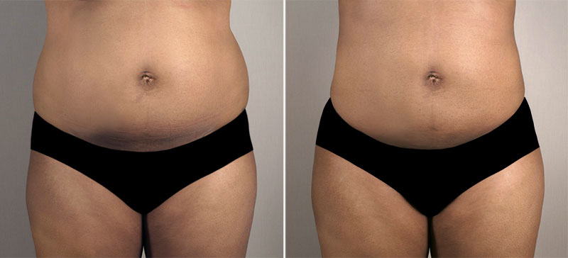 Liposuction Patient 38