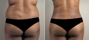 Liposuction Patient 38