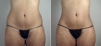 Liposuction of the Hips Patient 30