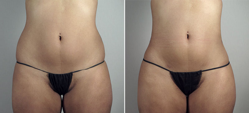Liposuction of the Hips Patient 30