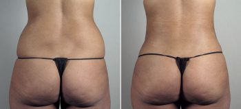 Liposuction of the Hips Patient 30