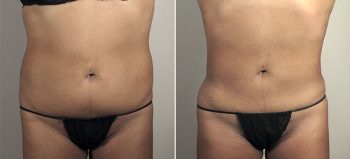 Liposuction Patient 39