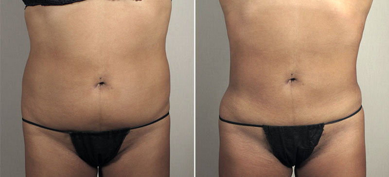 Liposuction Patient 39