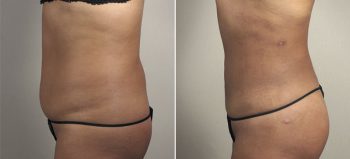 Liposuction Patient 39