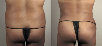 Liposuction Patient 39