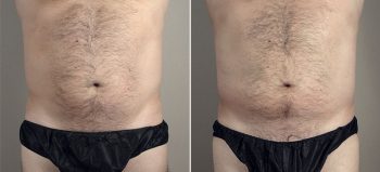 Male Liposuction Patient 27 & Gynecomastia