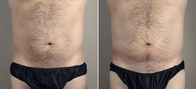 Male Liposuction Patient 27 & Gynecomastia